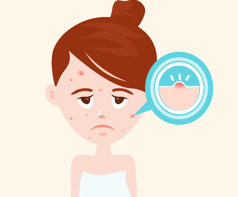 青春痘是如何产生的，长了青春痘该如何护理？